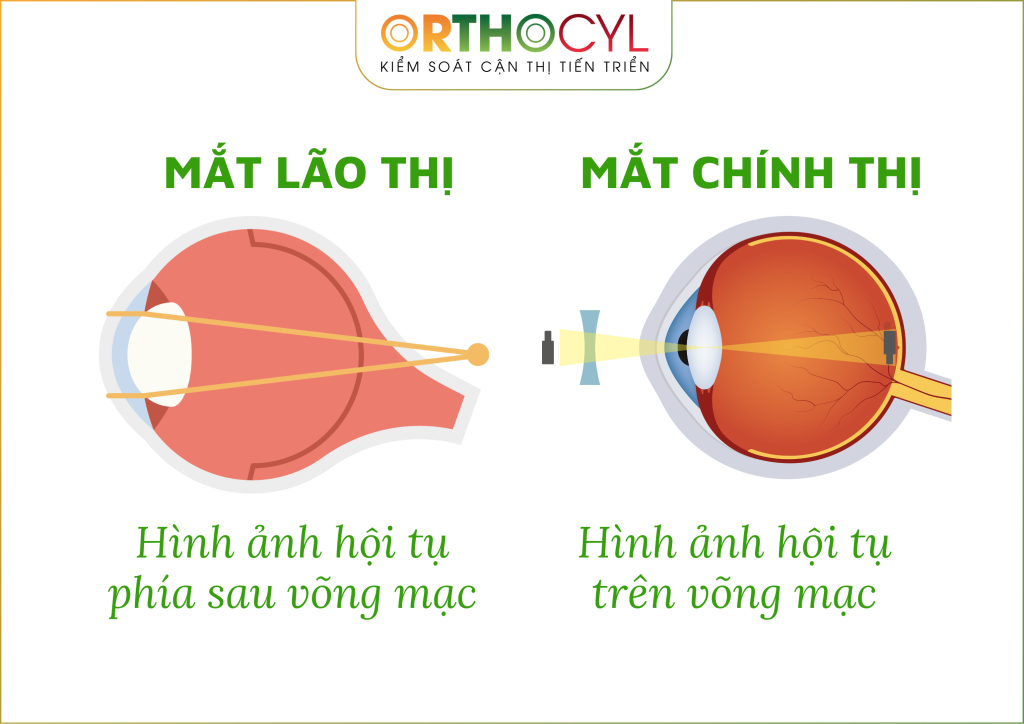 Kính ortho-k điều trị lão thị