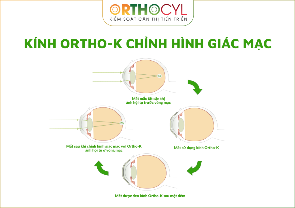 kính ortho-k