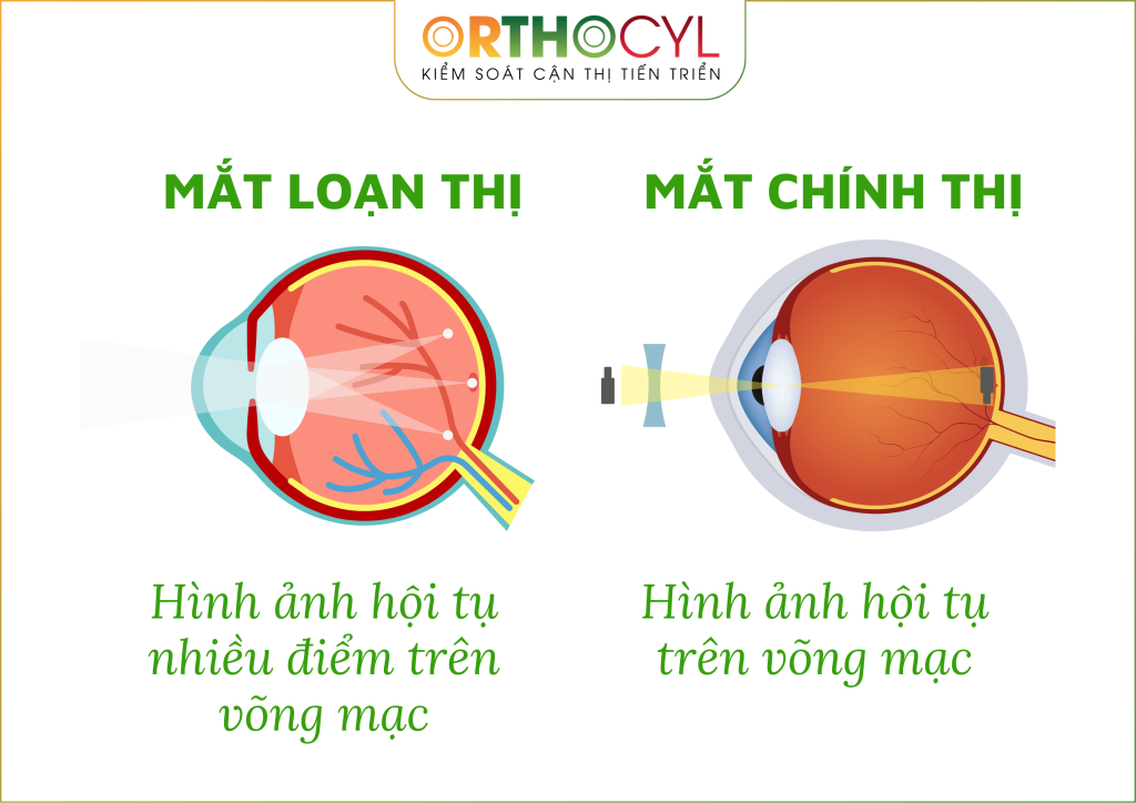 Kính ortho-k điều trị loạn thị
