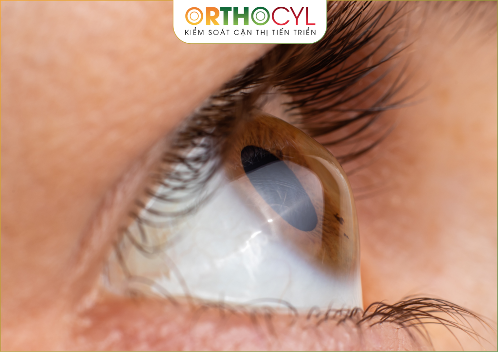 kính củng mạc (scleral)