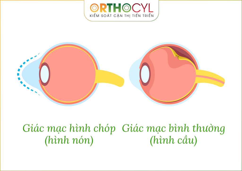 kính củng mạc (scleral)