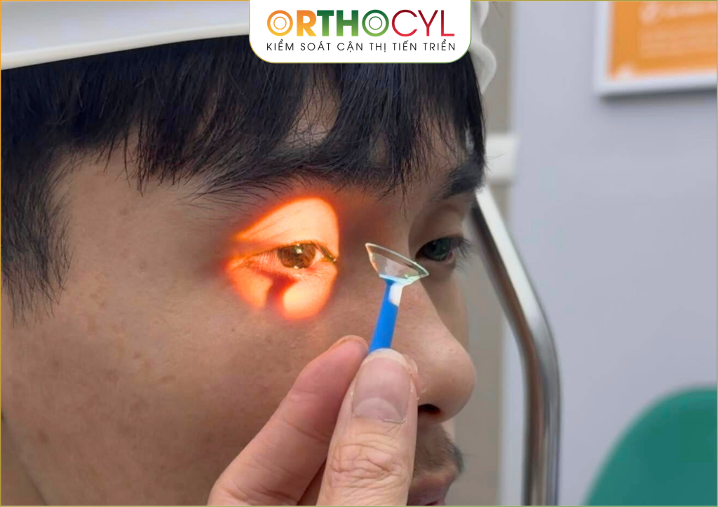 Kính Scleral điều trị giác mạc chóp