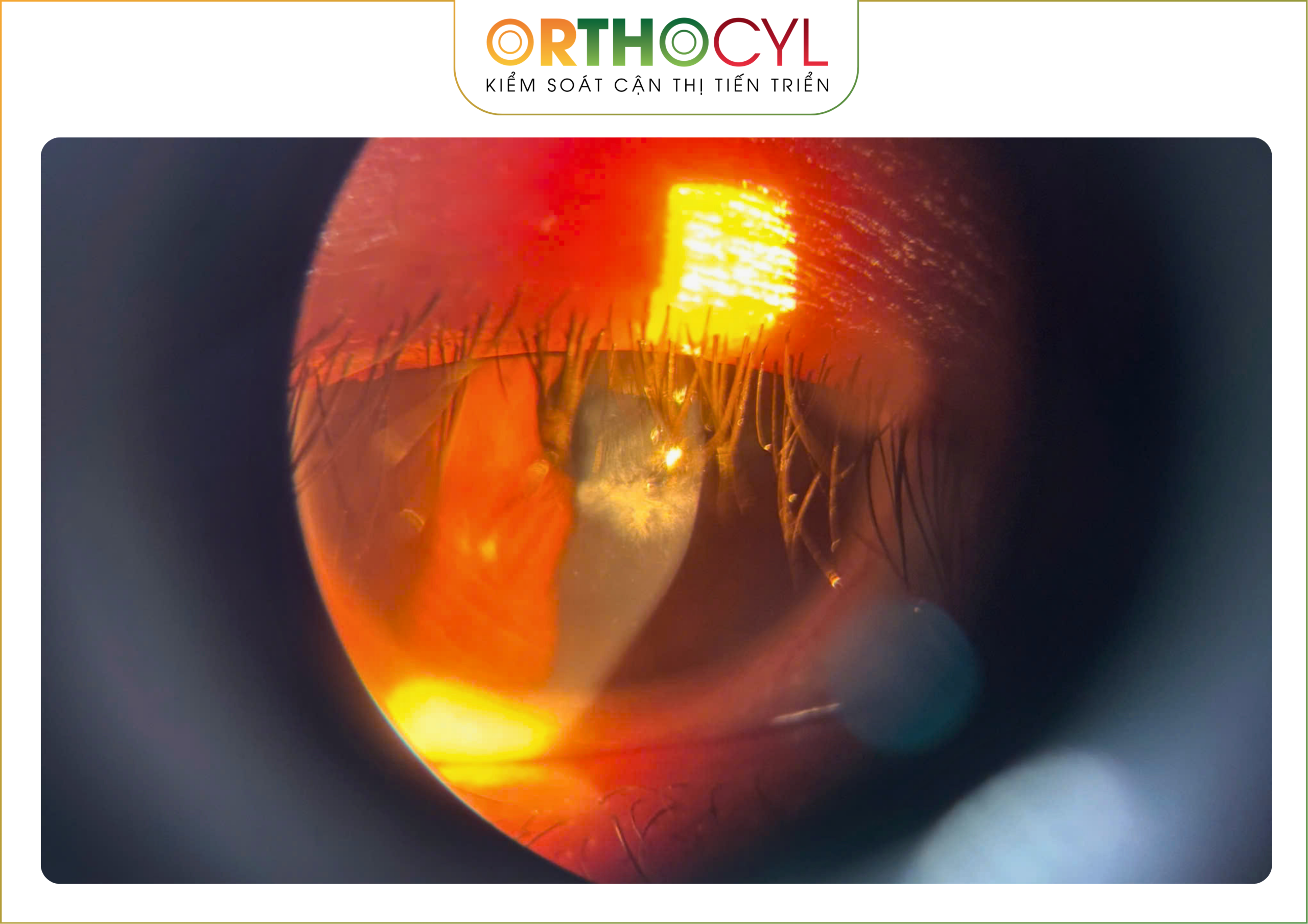 EyePrintPRO, kính củng mạc, scleral, giác mạc chóp, khô mắt, sẹo giác mạc, cận loạn cao, điều trị sau phẫu thuật