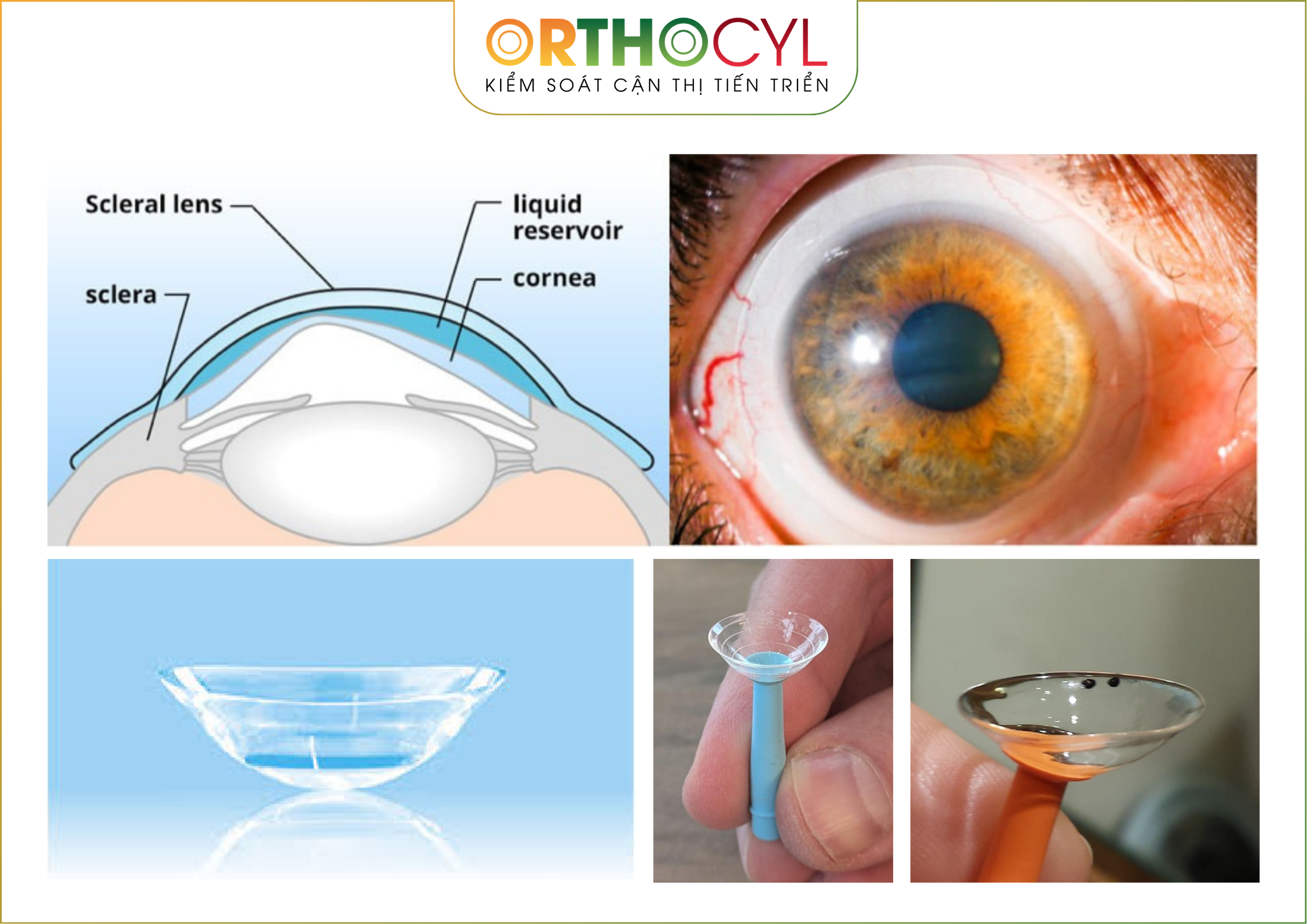 EyePrintPRO, kính củng mạc, scleral, giác mạc chóp, khô mắt, sẹo giác mạc, cận loạn cao, điều trị sau phẫu thuật