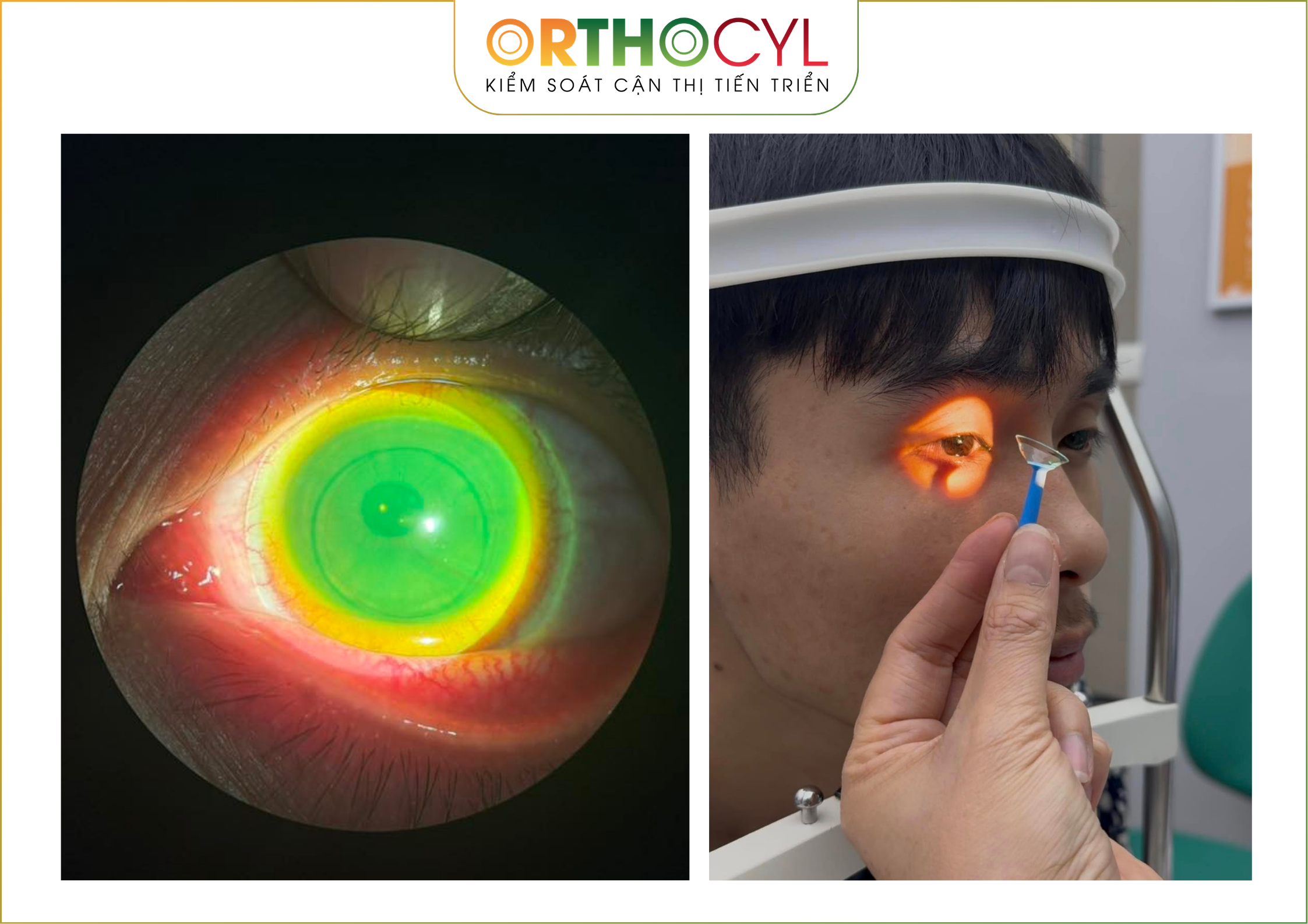 EyePrintPRO, kính củng mạc, scleral, giác mạc chóp, khô mắt, sẹo giác mạc, cận loạn cao, điều trị sau phẫu thuật