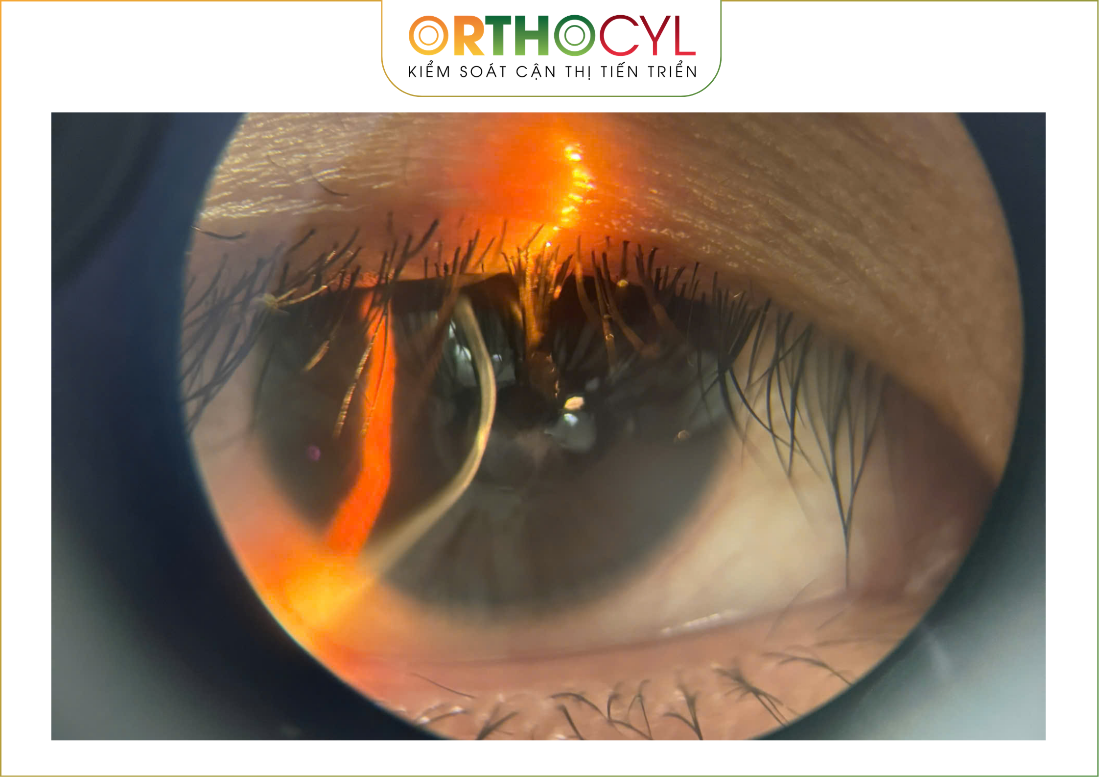 EyePrintPRO, kính củng mạc, scleral, giác mạc chóp, khô mắt, sẹo giác mạc, cận loạn cao, điều trị sau phẫu thuật