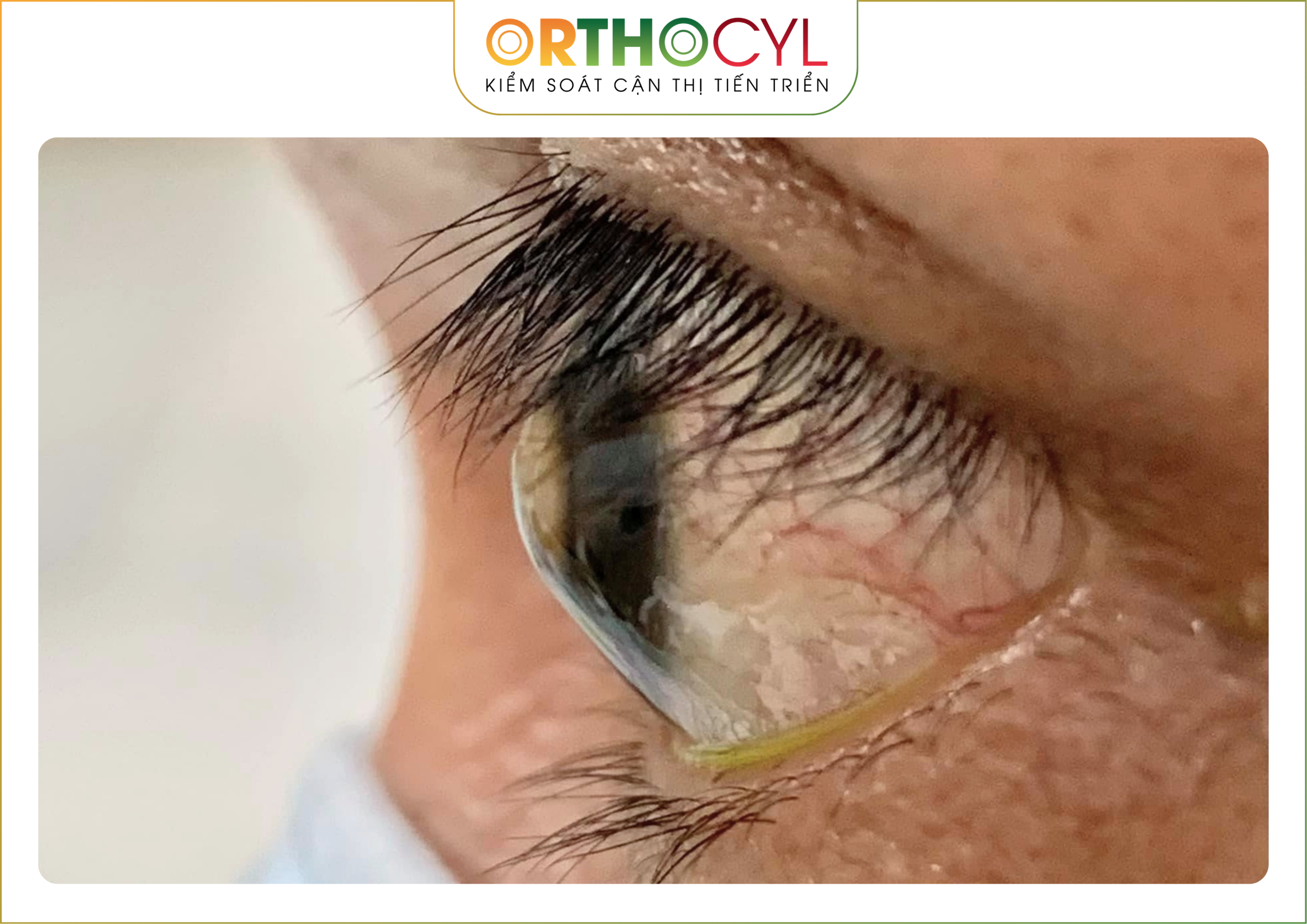 EyePrintPRO, kính củng mạc, scleral, giác mạc chóp, khô mắt, sẹo giác mạc, cận loạn cao, điều trị sau phẫu thuật