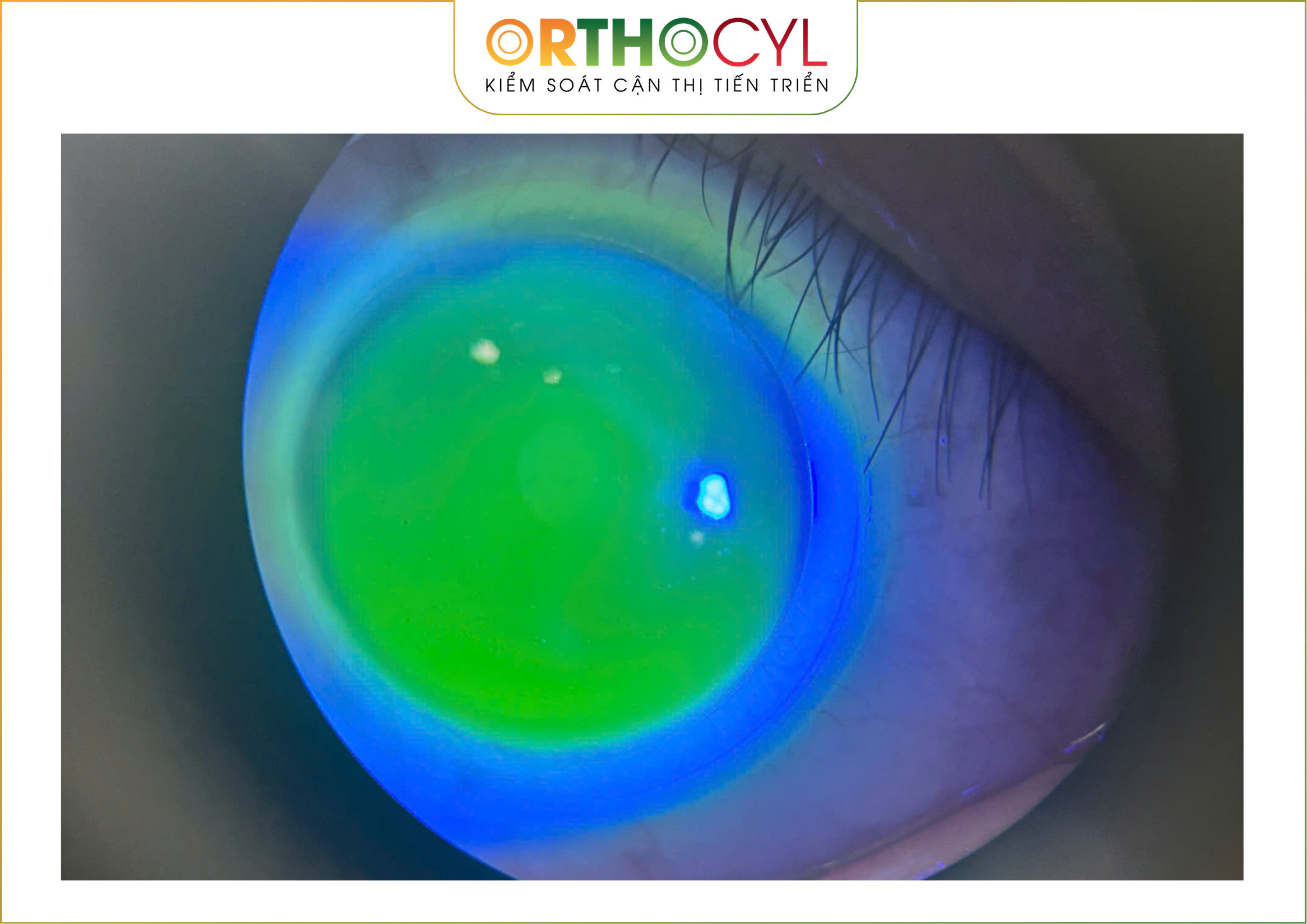 EyePrintPRO, kính củng mạc, scleral, giác mạc chóp, khô mắt, sẹo giác mạc, cận loạn cao, điều trị sau phẫu thuật