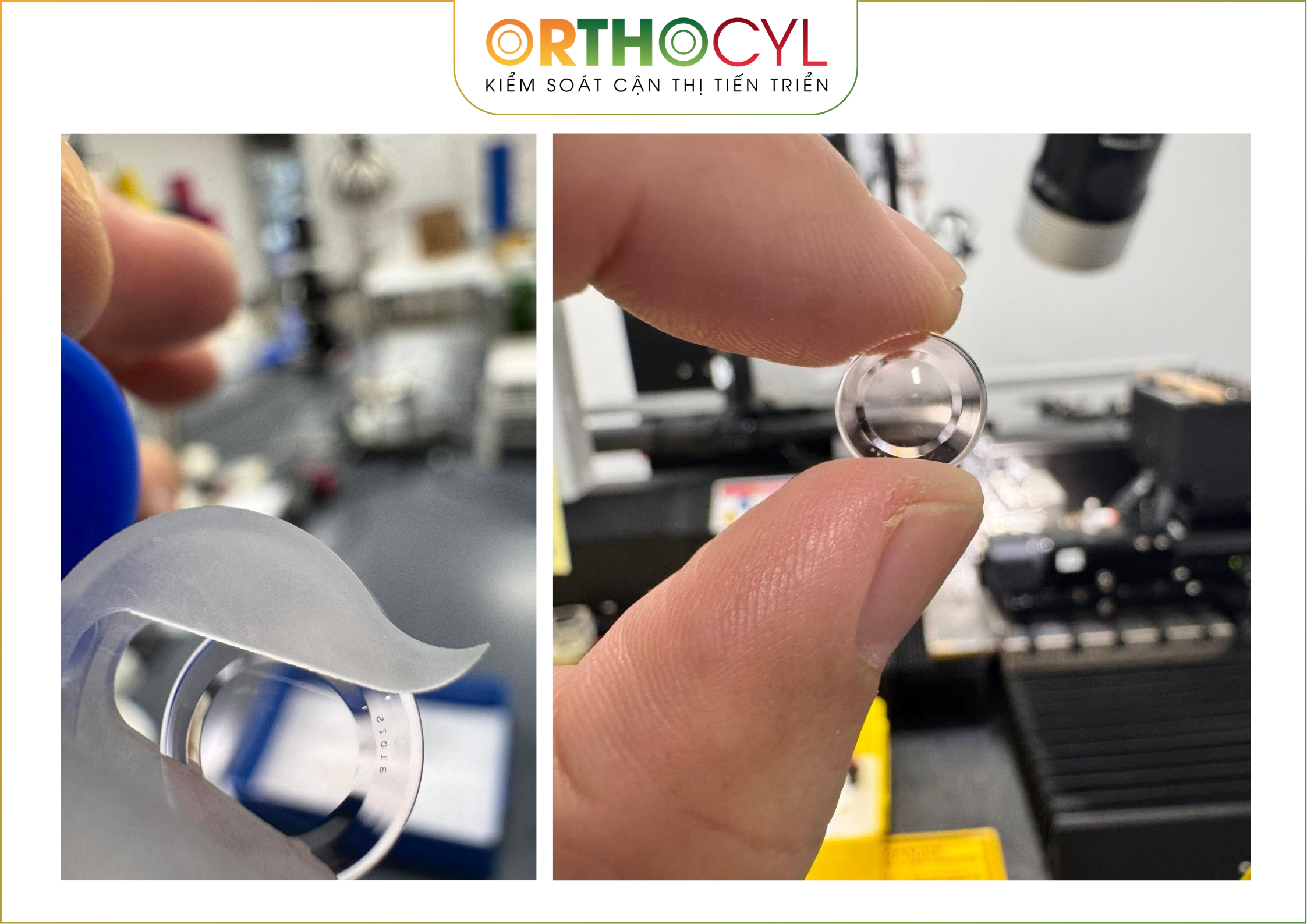 tái cận sau LASIK, tái cận sau mổ LASIK, bị cận lại sau LASIK, tái cận, sau LASIK có mổ lại được không, tái cận sau LASIK đeo kính gì, Ortho-K sau LASIK, Ortho-K cho người tái cận sau LASIK, Scleral sau LASIK, kính củng mạc sau LASIK, giác mạc không đều sau LASIK, loạn thị không đều sau LASIK, kính áp tròng sau LASIK, ortho-k, scleral, kính củng mạc