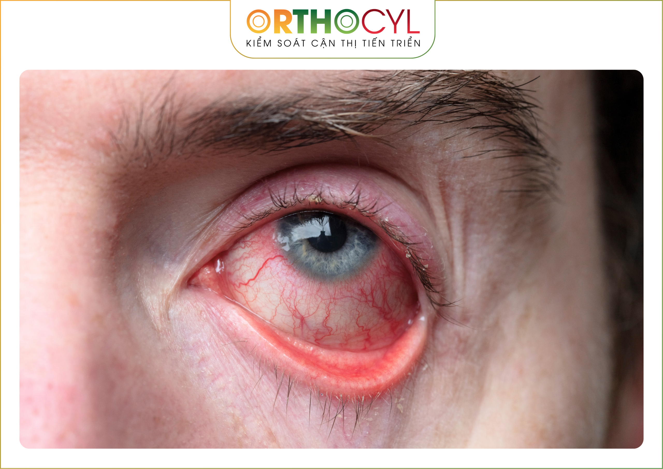EyePrintPRO, kính củng mạc, scleral, giác mạc chóp, khô mắt, sẹo giác mạc, cận loạn cao, điều trị sau phẫu thuật