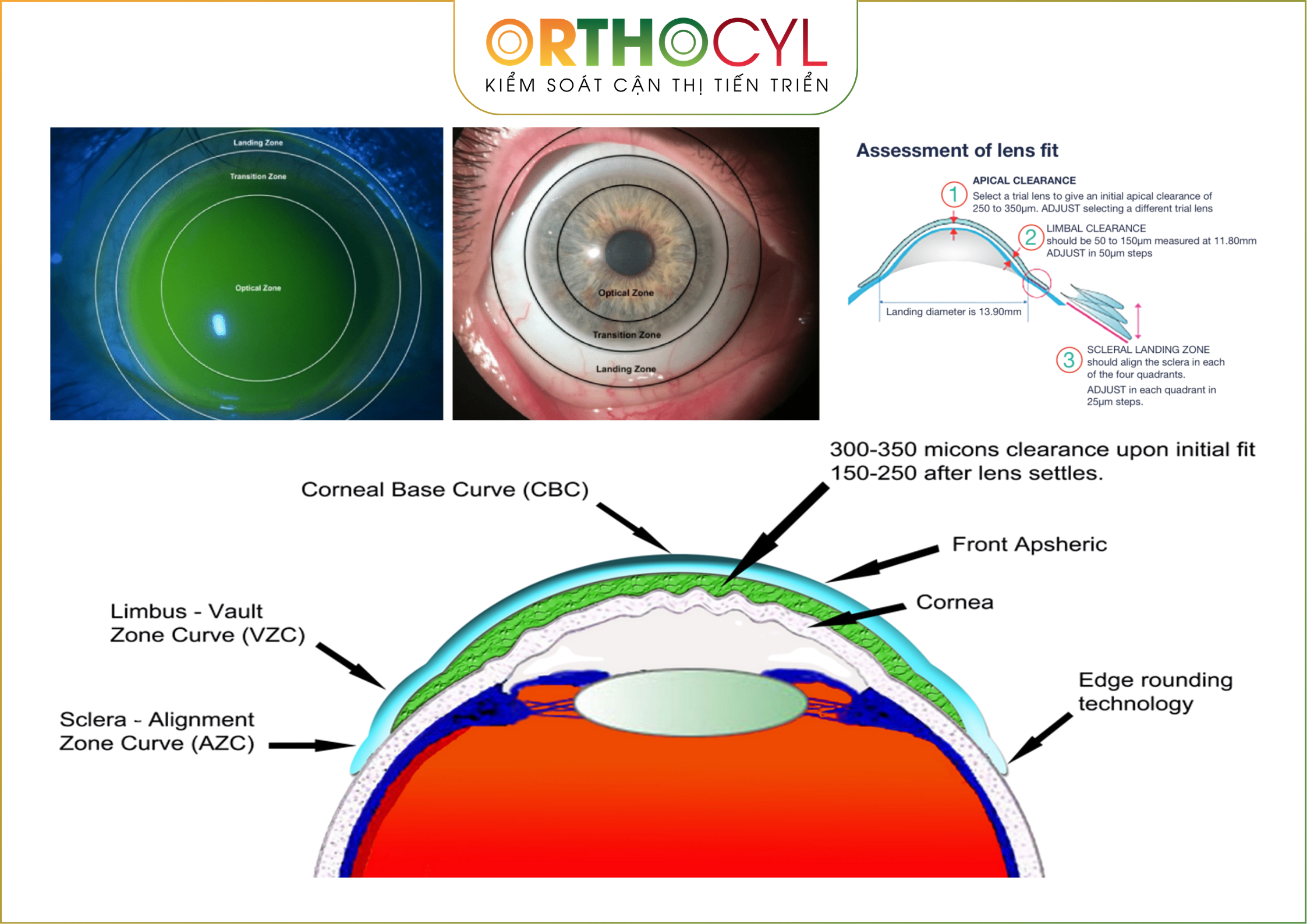 EyePrintPRO, kính củng mạc, scleral, giác mạc chóp, khô mắt, sẹo giác mạc, cận loạn cao, điều trị sau phẫu thuật