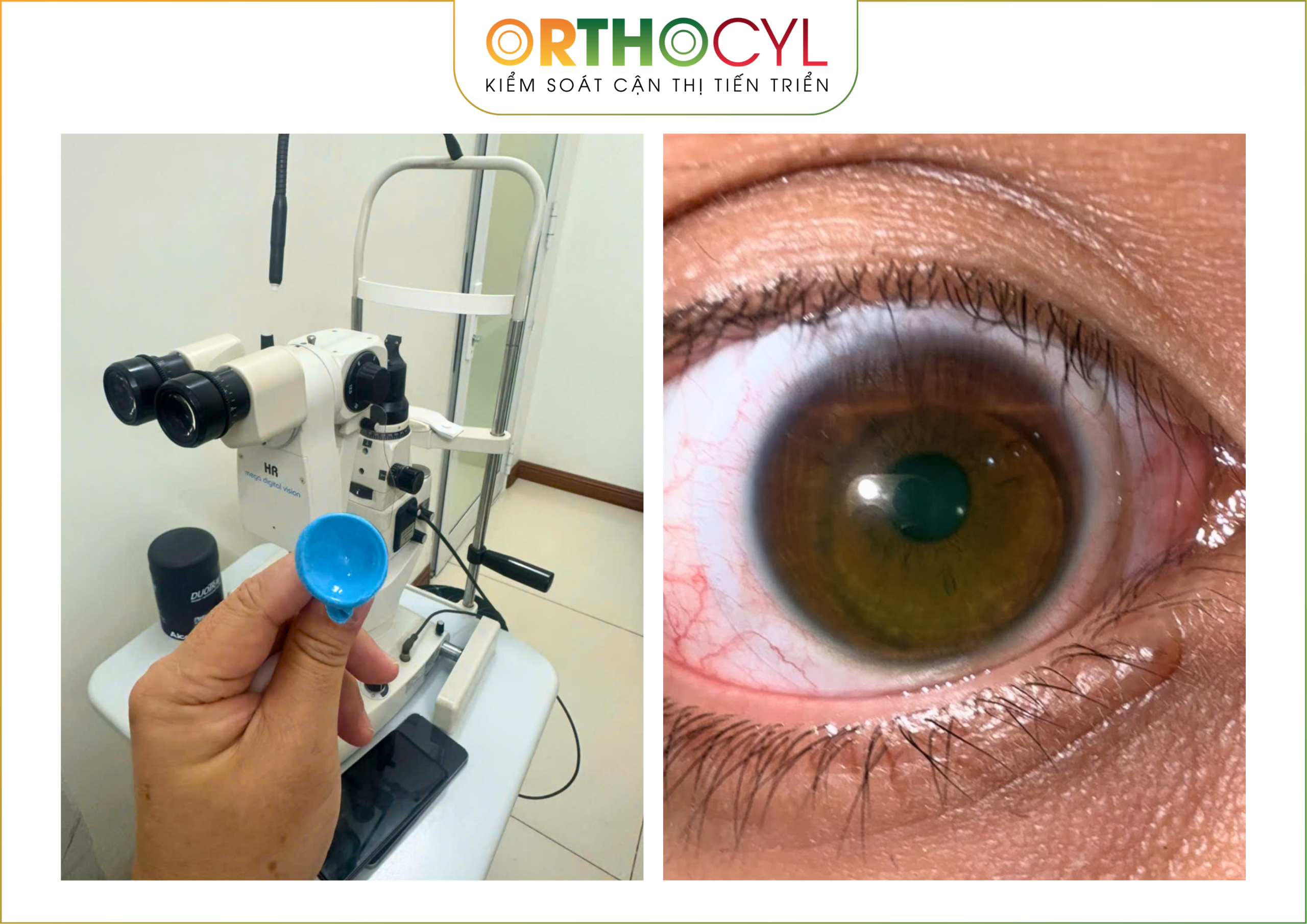 EyePrintPRO, kính củng mạc, scleral, giác mạc chóp, khô mắt, sẹo giác mạc, cận loạn cao, điều trị sau phẫu thuật
